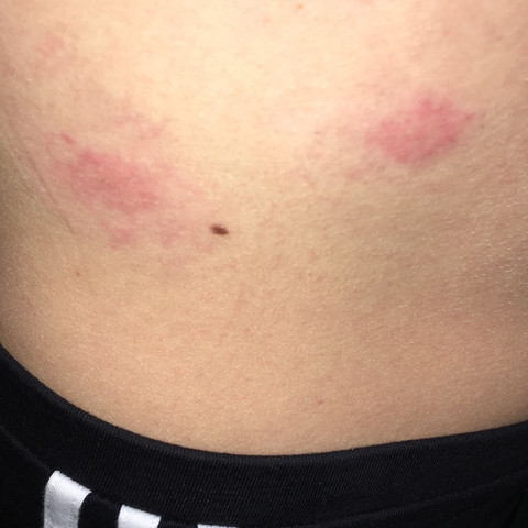 Was Ist Das Fur Ein Stich Kriebelmucke Jucken Mucken Bienen Was Ist Das Fur Ein Stich Kriebelmucke Jucken Mucken Bienen