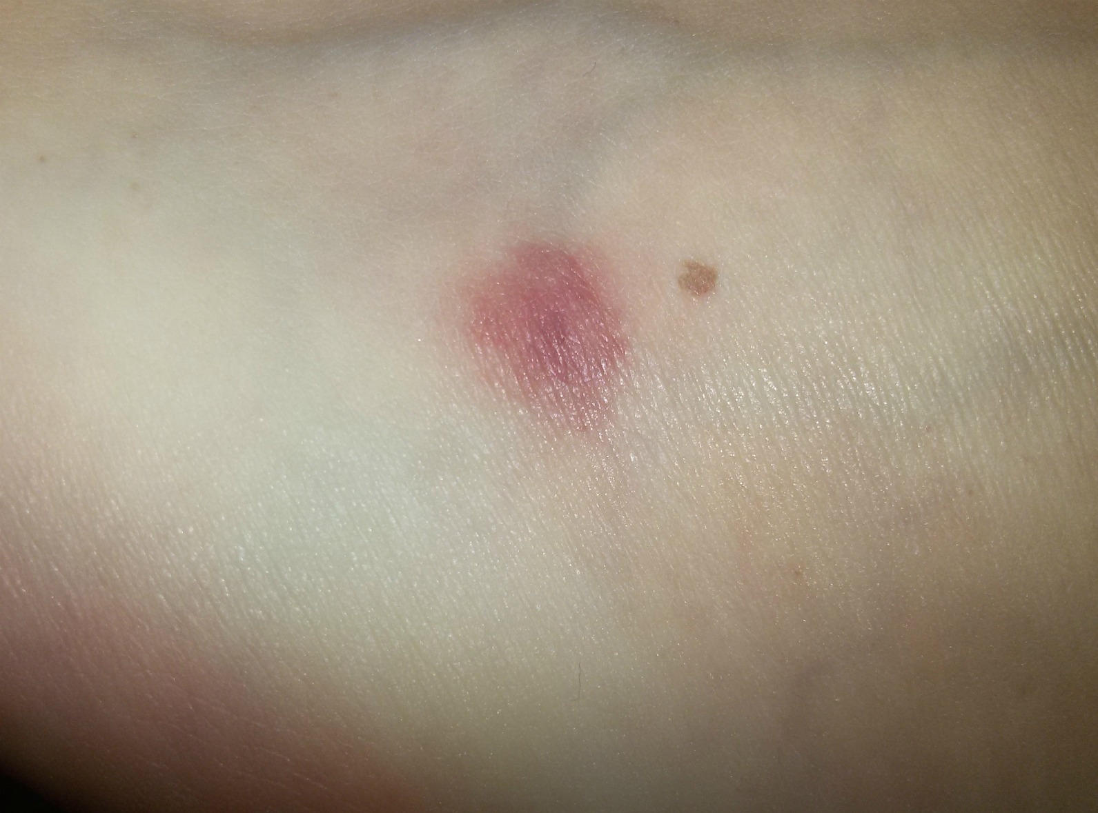 Was ist das für ein Stich bzw Biss? (Insekten, Flecken, rot)