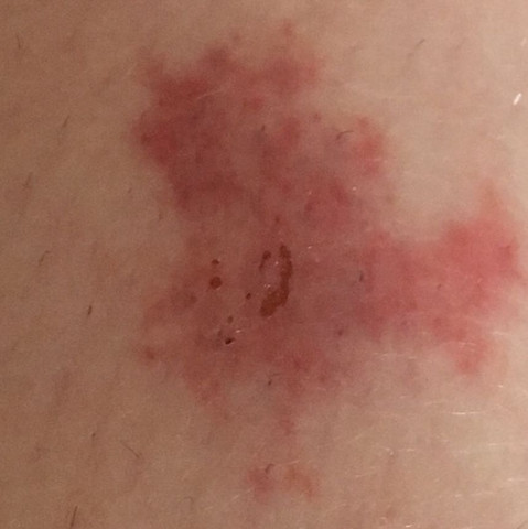 Bild des Stiches - (gefährlich, Stich)