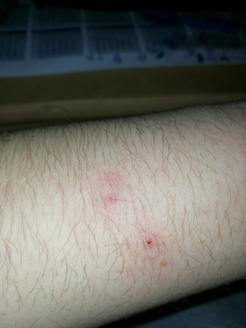 Was Ist Das Fur Ein Stich Biss Eventuell Bettwanze Insekten Bisse