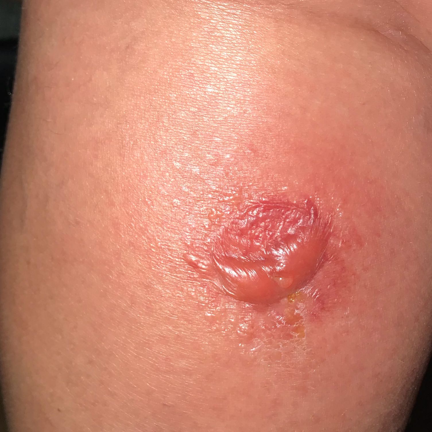 Was ist das für ein Stich?(Foto)? (Gesundheit und Medizin, Natur, Insekten) Was ist das für ein Stich?(Foto)? (Gesundheit und Medizin, Natur, Insekten)