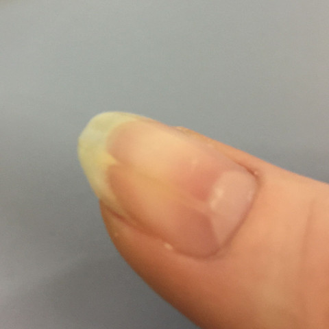Was Ist Das Fur Ein Strich Unter Meinem Nagel Fingernagel Verdickung Was Ist Das Fur Ein Strich Unter Meinem Nagel Fingernagel Verdickung