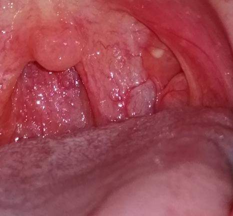 Was Ist Das Fur Ein Weisser Punkt Hno Rachen Was Ist Das Fur Ein Weisser Punkt Hno Rachen