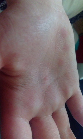 Linke Hand, Handfläche - (Allergie, Ausschlag, Hautausschlag)