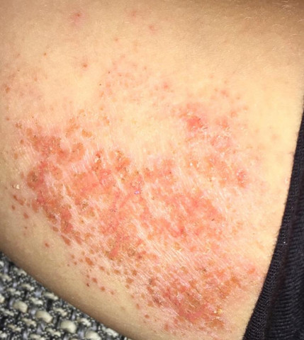 Was Ist Das Fur Eine Allergische Reaktion Auf Der Haut Gesundheit Und Medizin Medizin Allergie Was Ist Das Fur Eine Allergische Reaktion Auf Der Haut Gesundheit Und Medizin Medizin Allergie