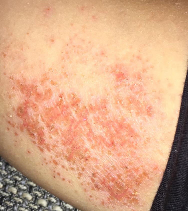 Was ist das für eine allergische Reaktion auf der Haut? (Gesundheit und