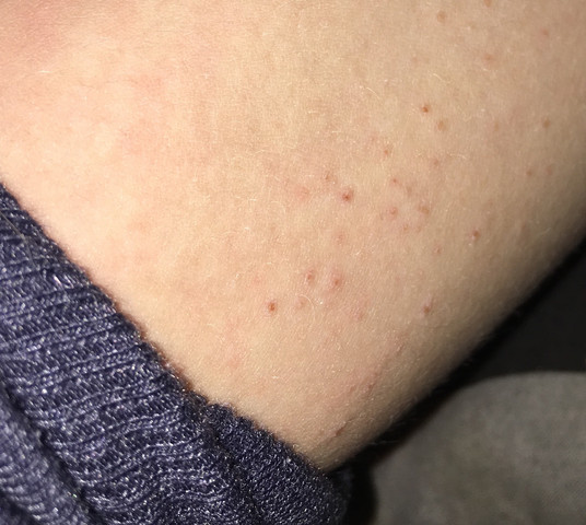 Was Ist Das Fur Eine Allergische Reaktion Auf Der Haut Gesundheit Und Medizin Medizin Allergie Was Ist Das Fur Eine Allergische Reaktion Auf Der Haut Gesundheit Und Medizin Medizin Allergie