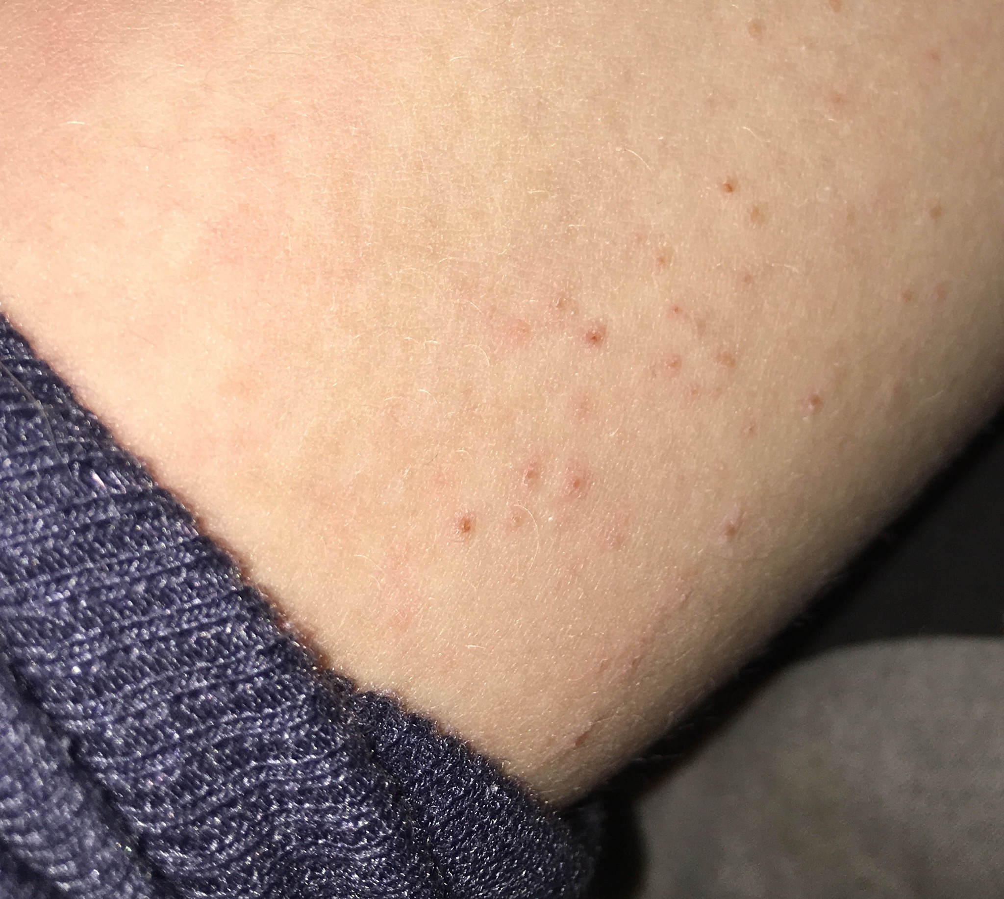 Was ist das für eine allergische Reaktion auf der Haut? (Gesundheit und