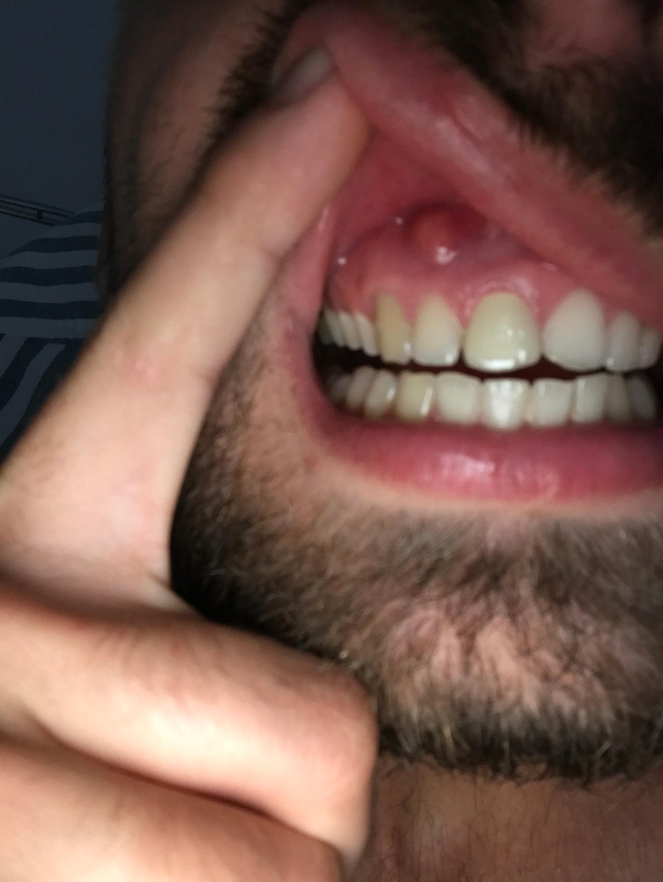 Was Ist Das Fur Eine Beule Am Zahnfleisch Oben Links Gesundheit Und Medizin Krankheit Zahnmedizin Was Ist Das Fur Eine Beule Am Zahnfleisch Oben Links Gesundheit Und Medizin Krankheit Zahnmedizin