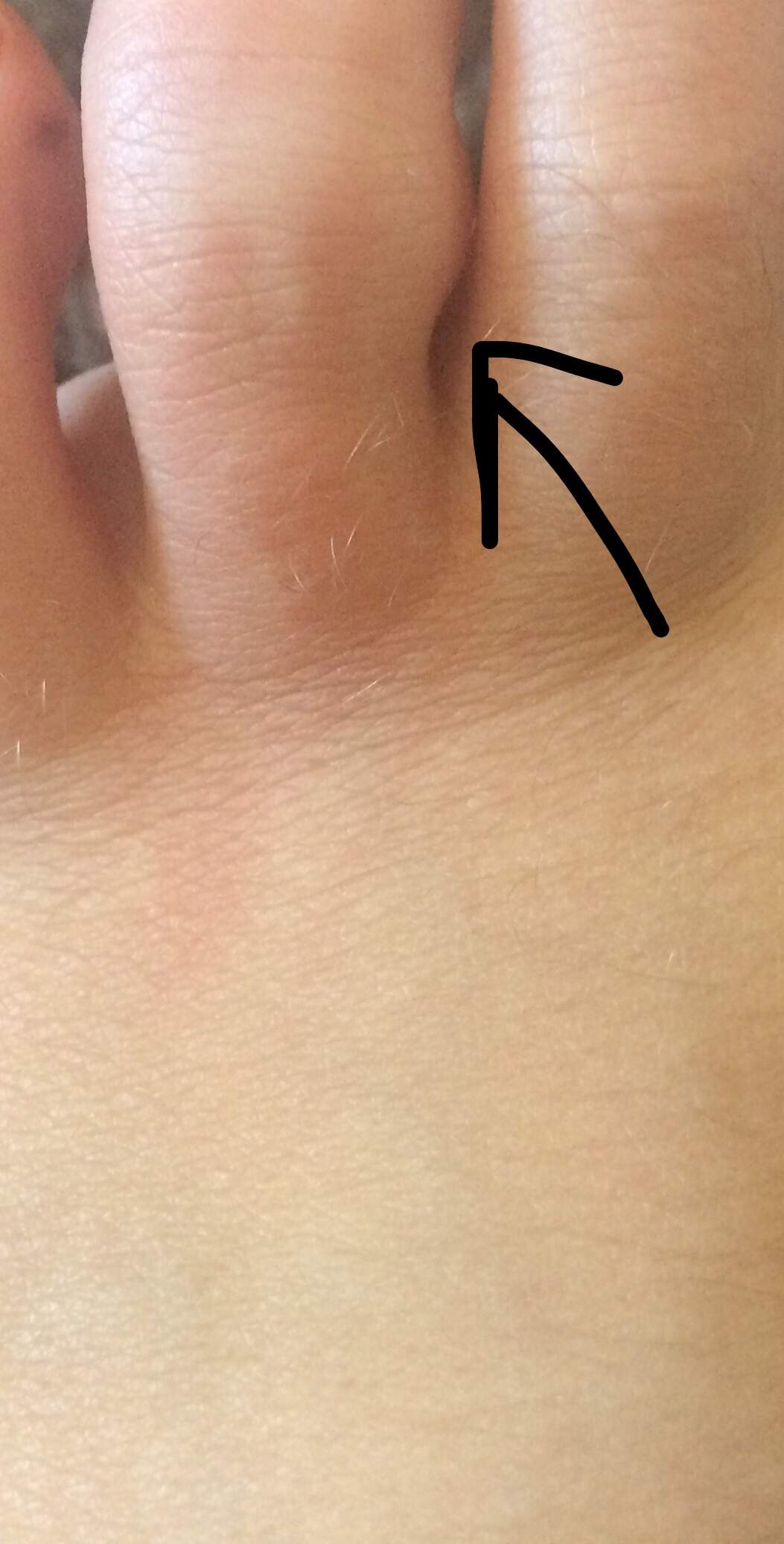 Beule Was ist das für eine Beule am Zeh und wie kriegt man diese bei welchem ...