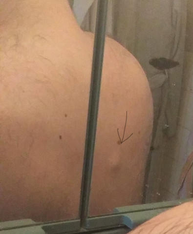 Was Ist Das Fur Eine Beule An Der Wirbelsaule Gesundheit Rucken Neurologe Was Ist Das Fur Eine Beule An Der Wirbelsaule Gesundheit Rucken Neurologe
