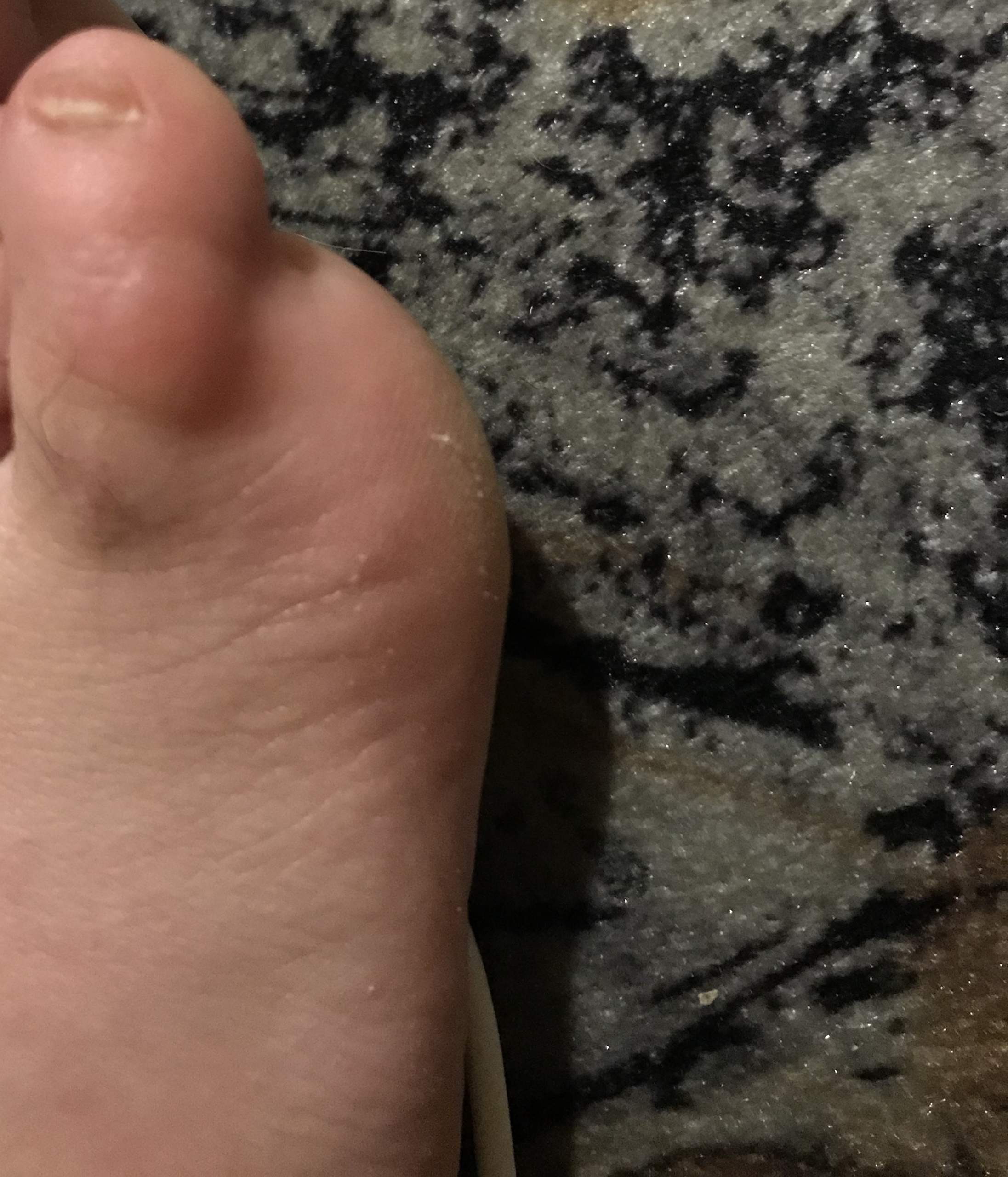 Was ist das für eine Beule an meiner Zehe? (Zeh)