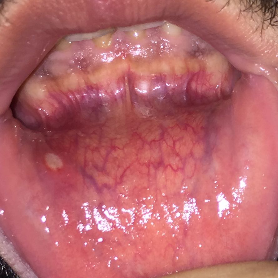 Was ist das für eine blase und wie bekomme ich das weg? (Gesundheit und Medizin, unterlippe)