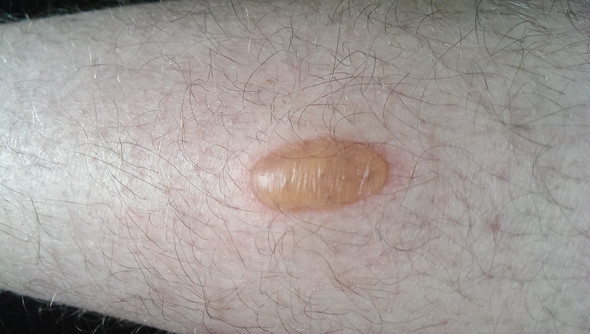 Was ist das für eine Blase und woher kommt sie? (Gesundheit, Haut ...