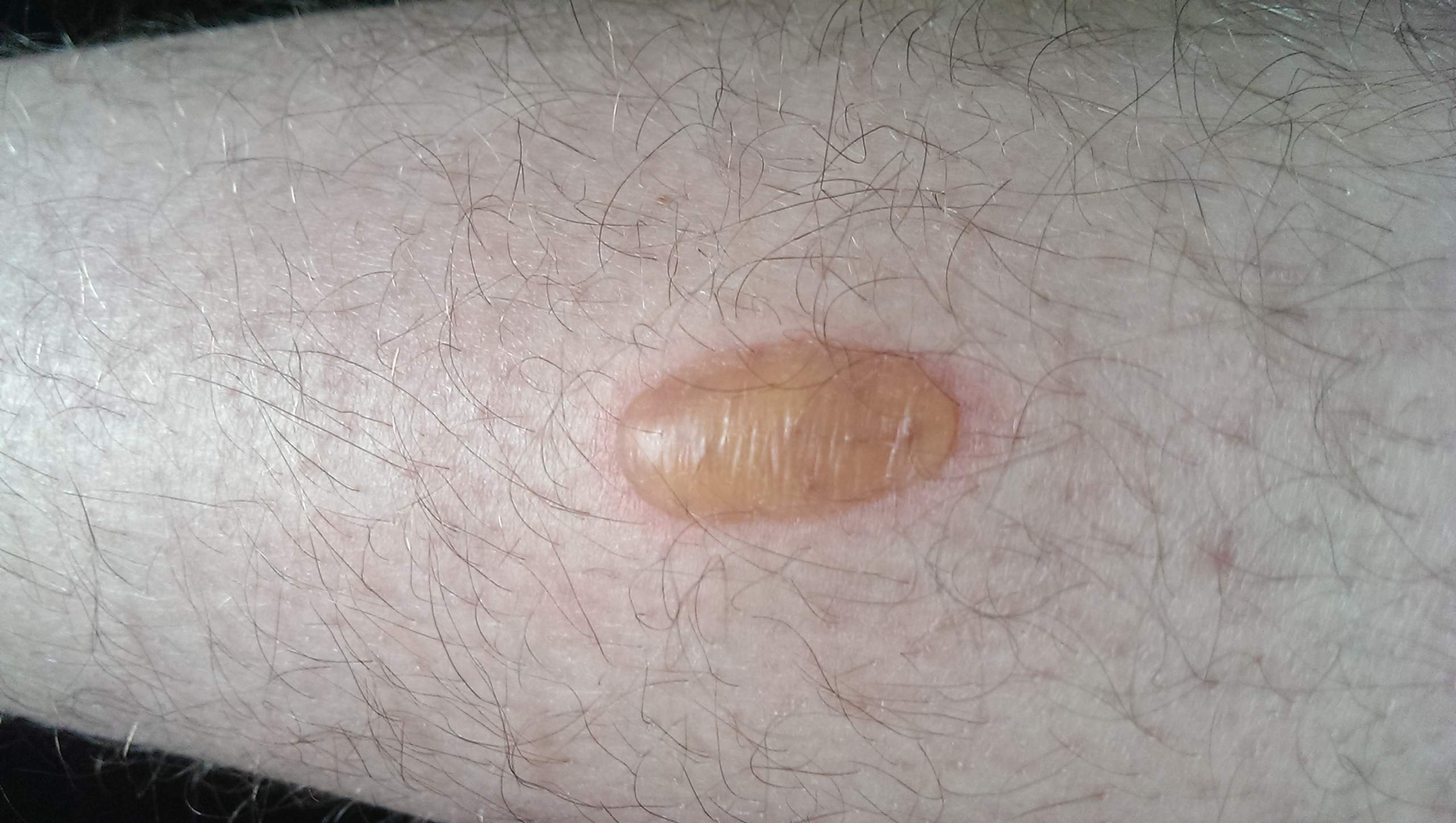 Was ist das für eine Blase und woher kommt sie? (Gesundheit, Haut
