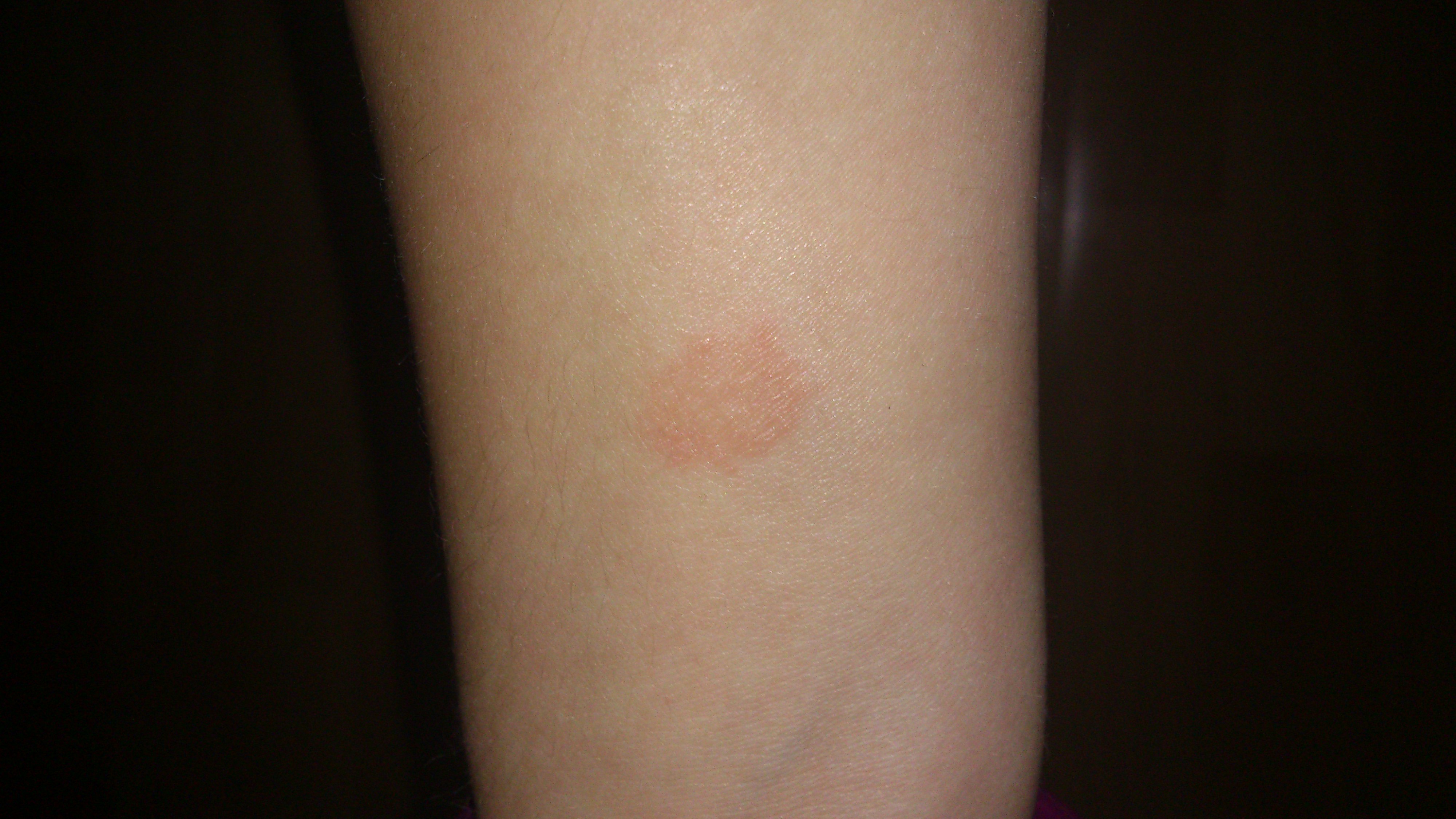 was ist das für eine entzündung / Krankheit? roter fleck am arm? (Haut)