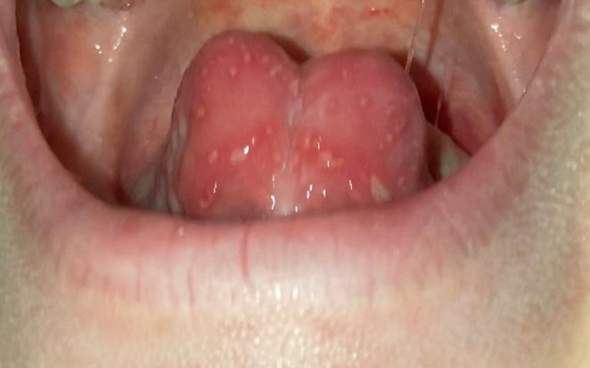 Was ist das für eine Entzündung unterhalb meiner Zunge und was kann ich dagegen machen?