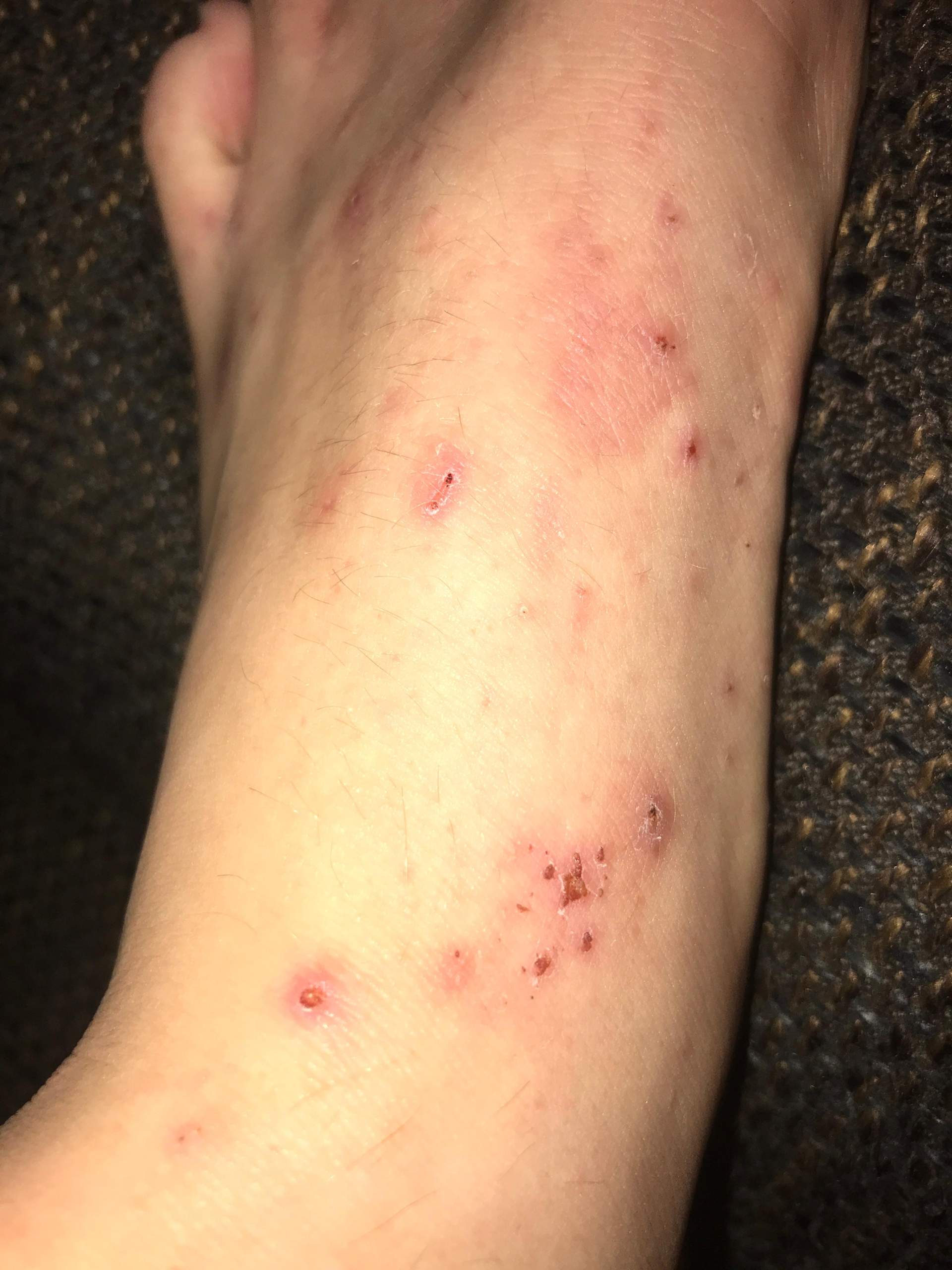 Was ist das für eine Hautirritation bzw. Krankheit? (Hautpflege