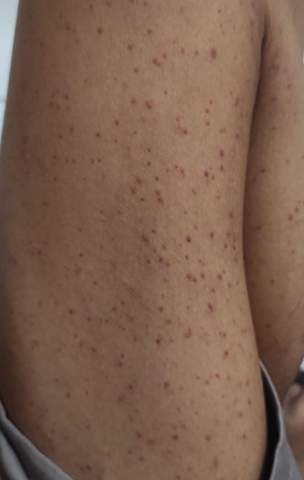 Was ist das für eine Hautkrankheit?