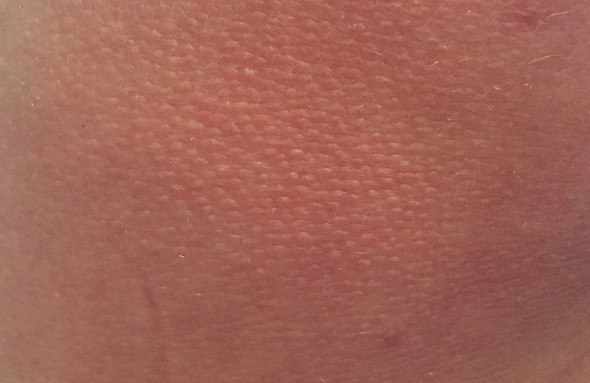 Hautstelle - (Haut, Dermatologie)
