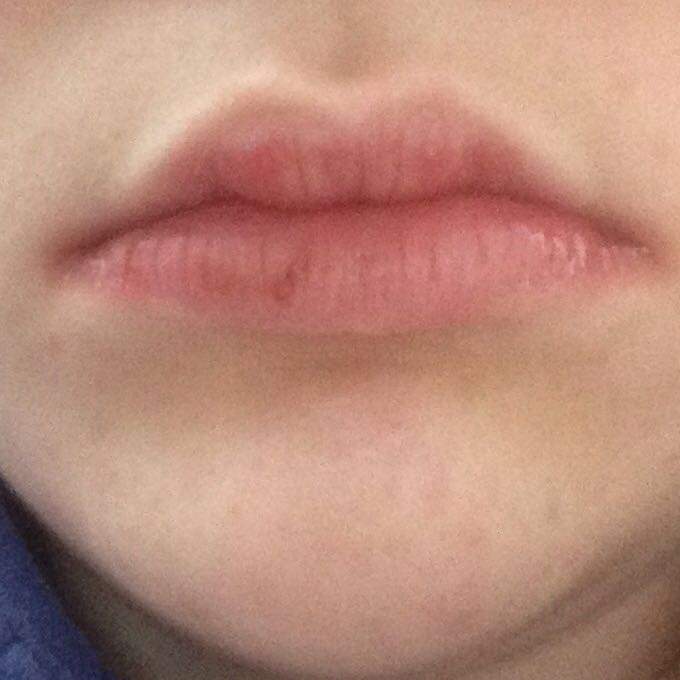 An lippen schwellen Geschwollene Lippen: