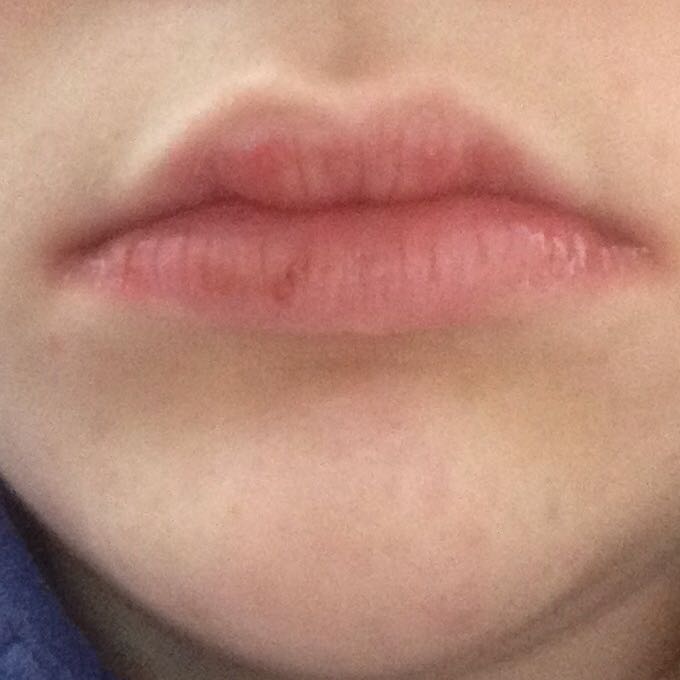 Was Ist Das Fur Eine Infektion An Den Lippen Lippe Pilze Was Ist Das Fur Eine Infektion An Den Lippen Lippe Pilze