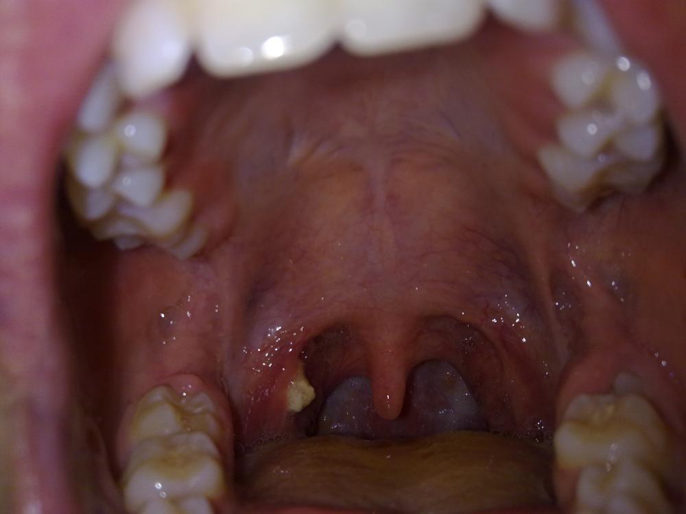 was ist das für eine rachenentzündung? (Gesundheit, Körper, Mund)