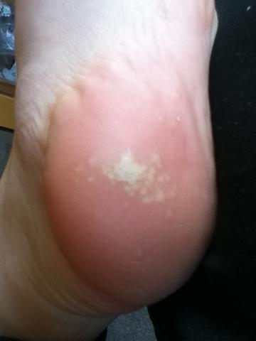 Fuß durch stoß stark blau? (gesundheit und medizin, füße, schwellung) Was ist das für eine Stelle an meinem Fuß, Bitte helfen dringend