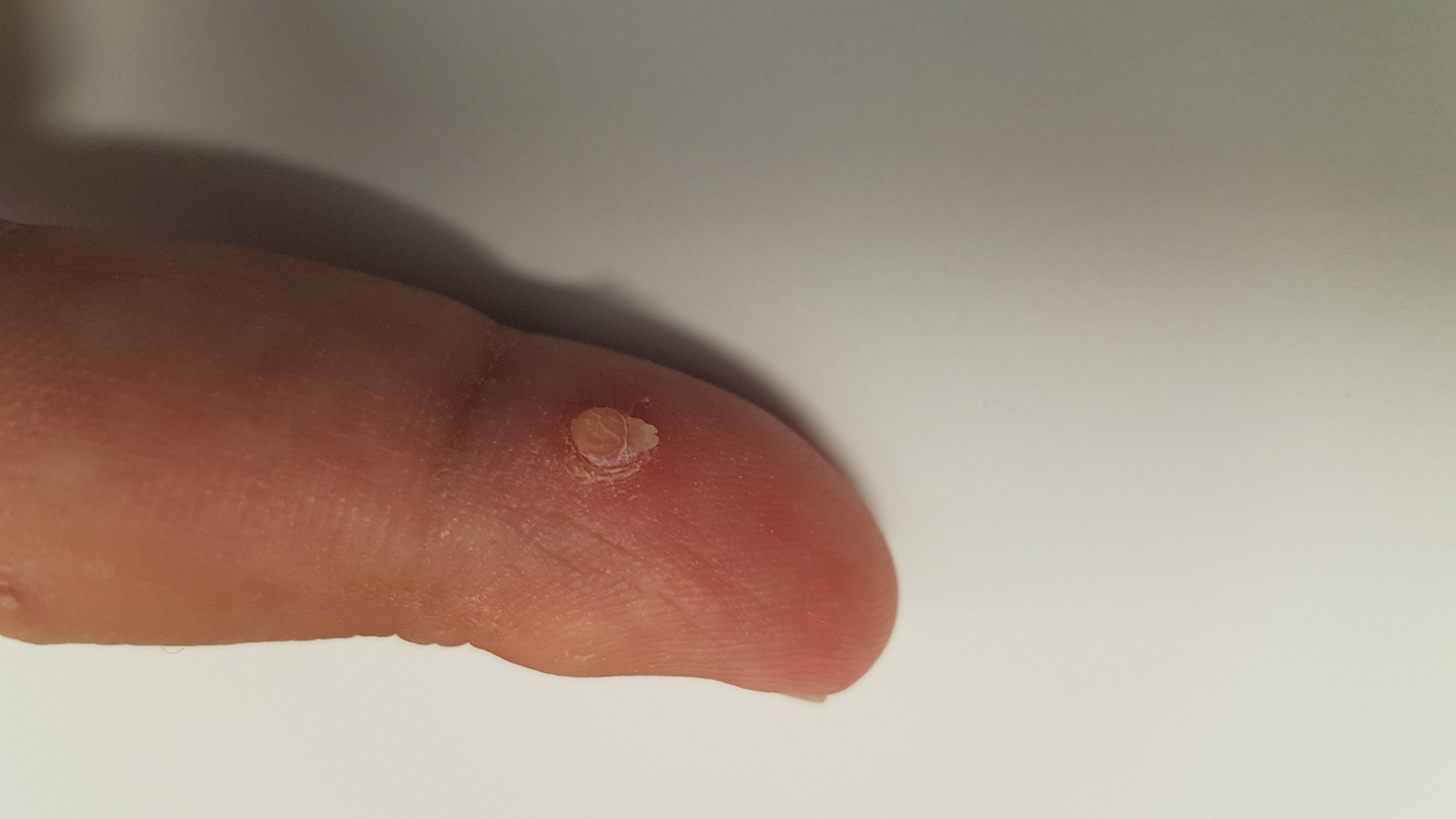 Was ist das für eine Warze auf den Fotos und wie werde ich die los Was ist das für eine Warze auf den Fotos und wie werde ich die los