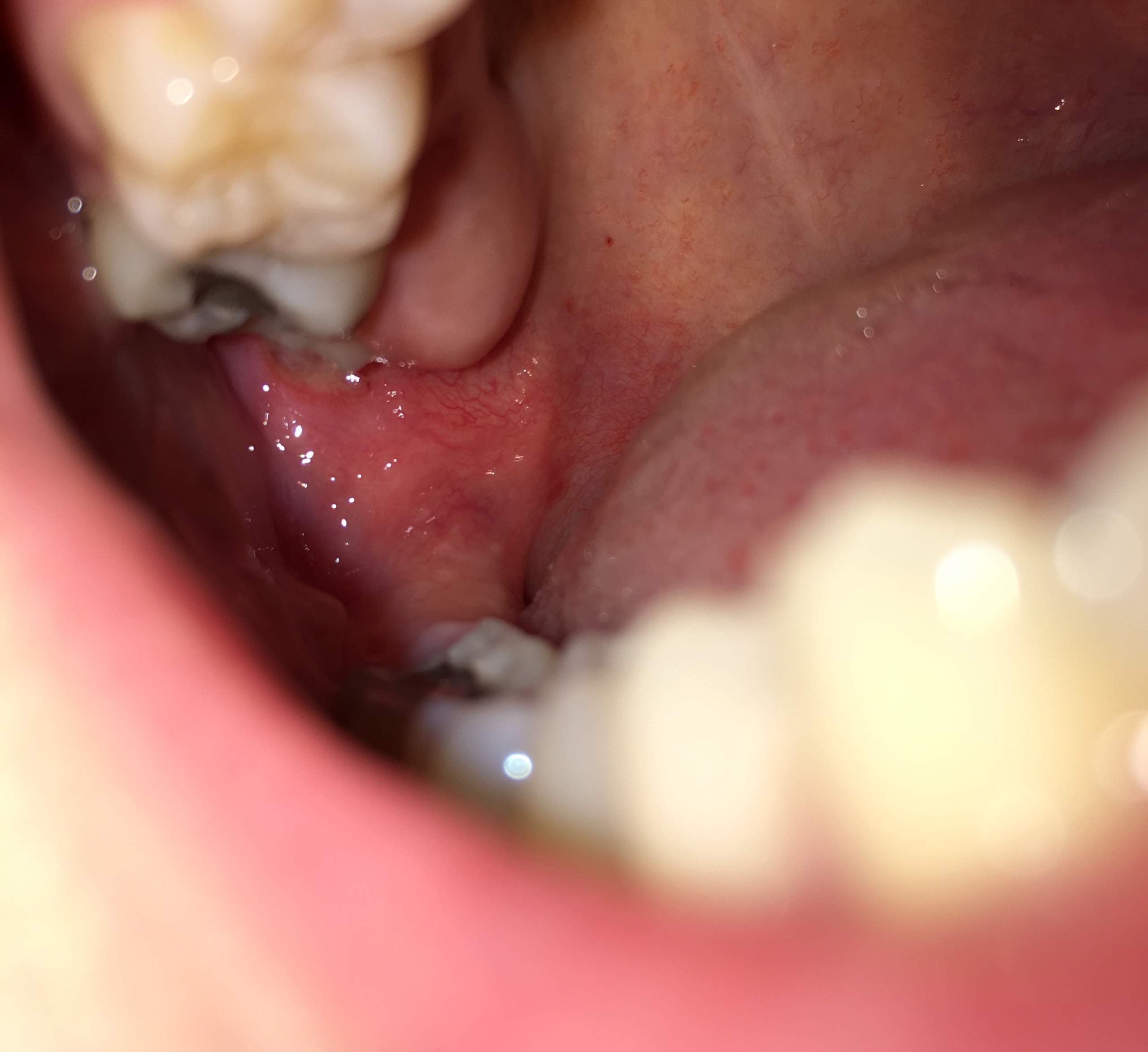 Weisheitszahn Op Wunde Blutet Nach 5 Tagen Was ist das für eine Wunde hinter meinem wachsenden Weisheitszahn