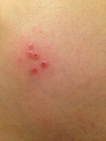 Flohe Und Flohbisse Bei Mensch Und Tier Was Kann Man