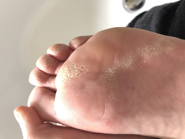 Was Ist Das Fusspilz Was Kann Ich Tun Fusse Pilze Was Ist Das Fusspilz Was Kann Ich Tun Fusse Pilze