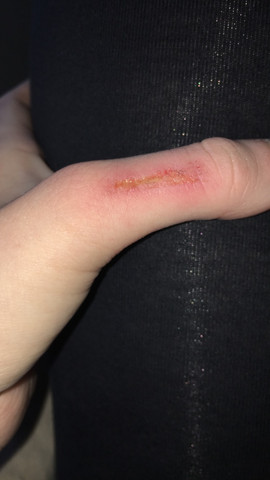 Was Ist Das Gelbe An Der Wunde Medizin Was Ist Das Gelbe An Der Wunde Medizin