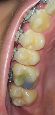 Das ist das grüne in meinem Backenzahn  - (Zähne, Zahnarzt, Zahnmedizin)