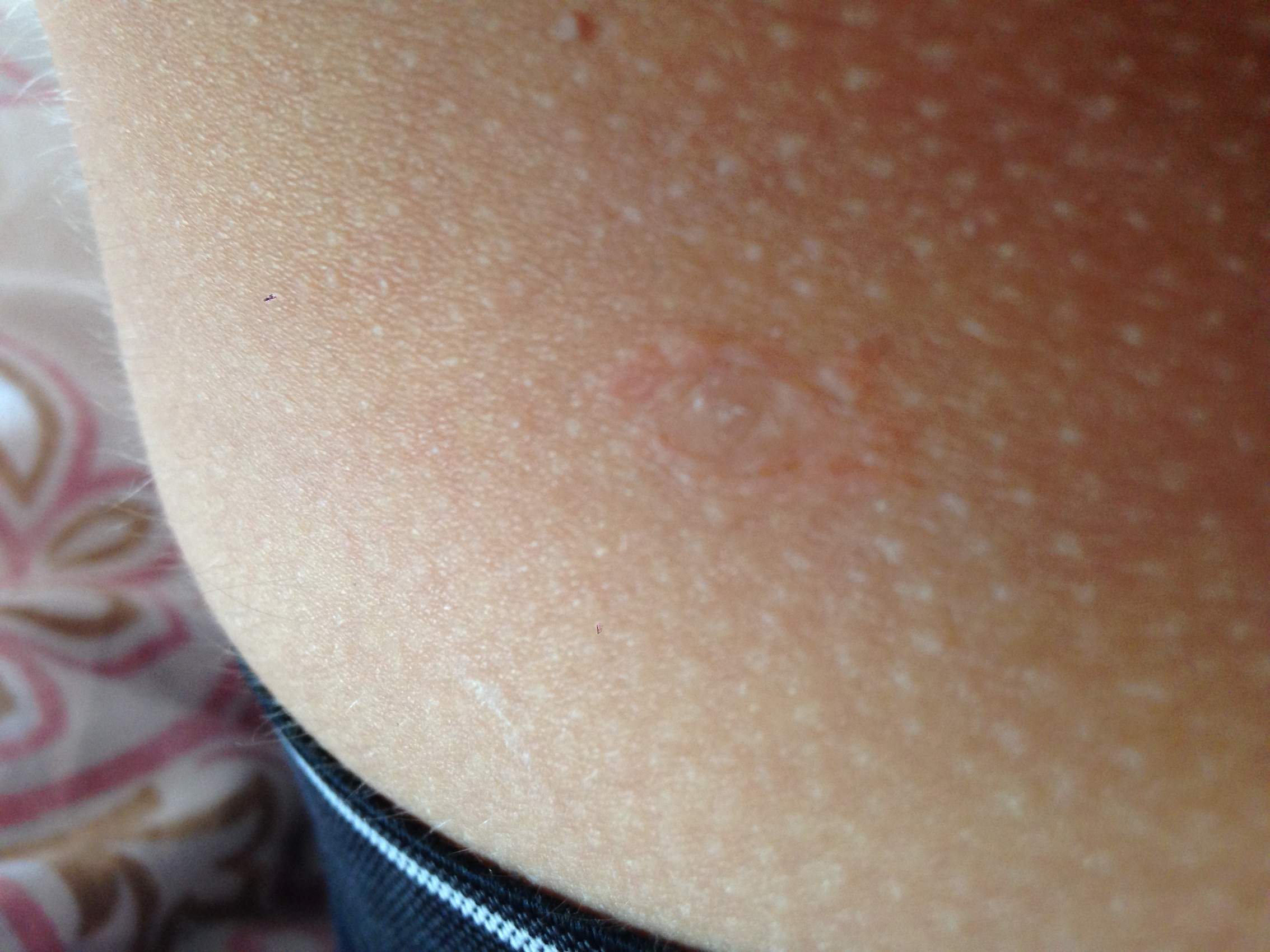 Was ist das? Gürtelrose? (Krankheit, Herpes, Immunsystem)