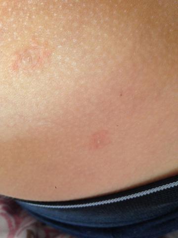 Was Ist Das Gurtelrose Krankheit Herpes Immunsystem Was Ist Das Gurtelrose Krankheit Herpes Immunsystem