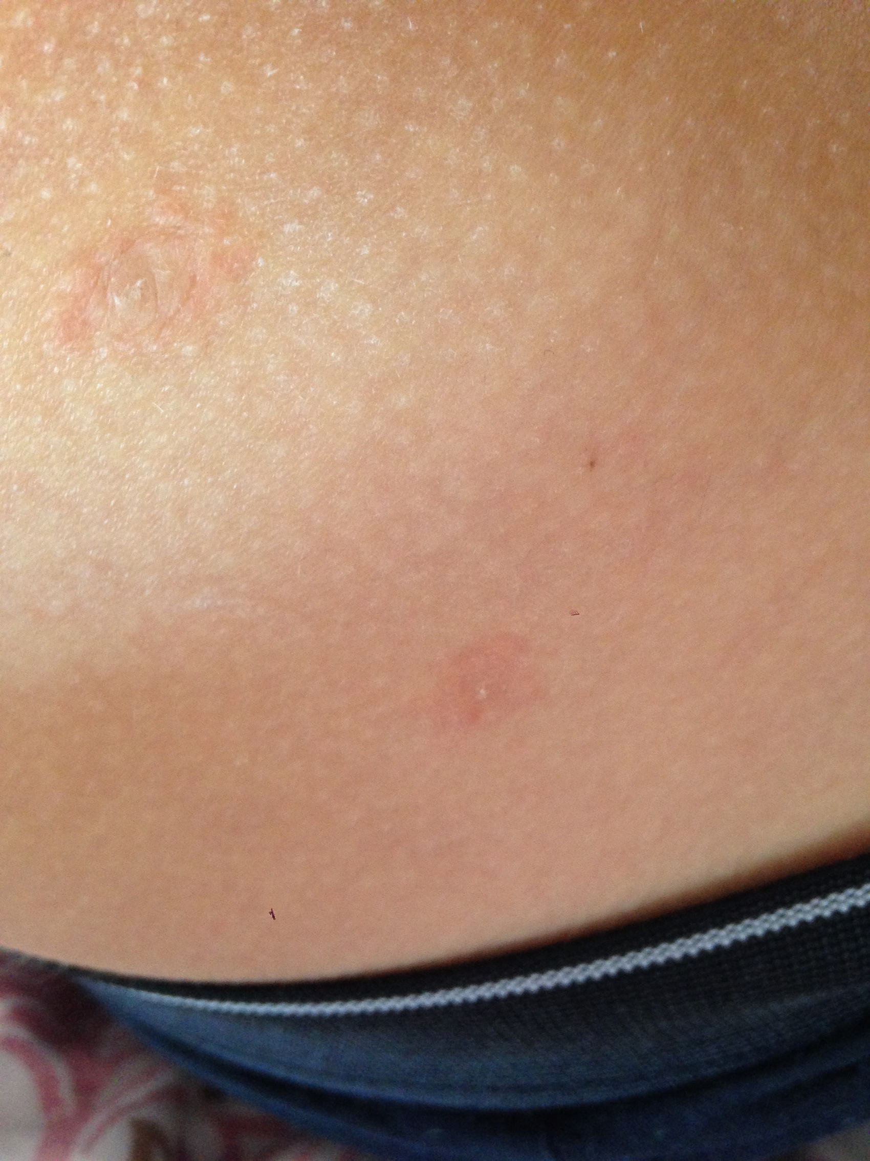 Was ist das? Gürtelrose? (Krankheit, Herpes, Immunsystem)