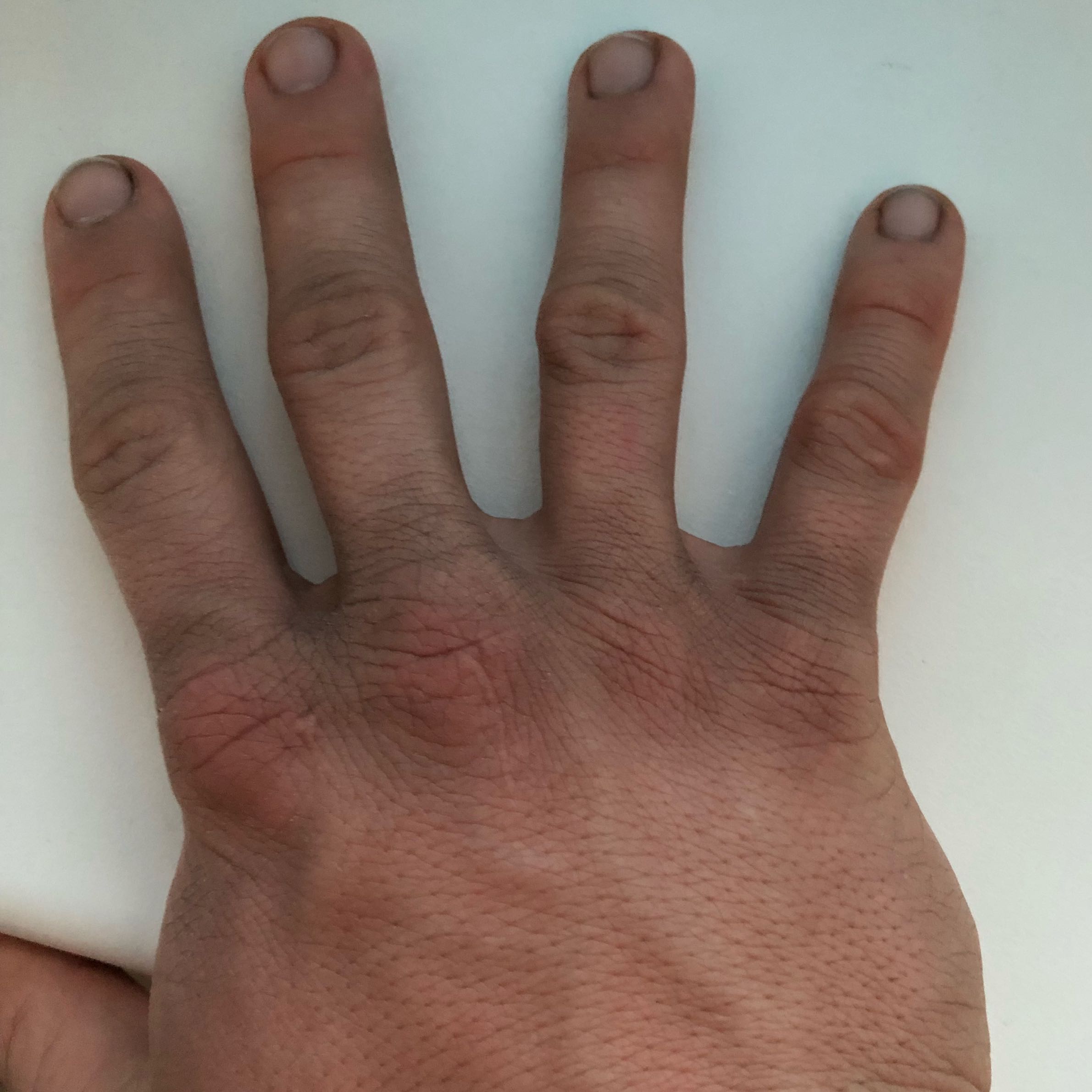 Was ist das? Hand schwarz? (Medizin, Haut, Hautarzt)