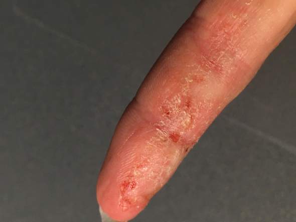 - (Finger, Extreme Hauptprobleme )
