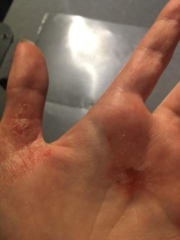 - (Finger, Extreme Hauptprobleme )