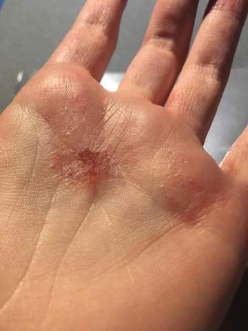 - (Finger, Extreme Hauptprobleme )