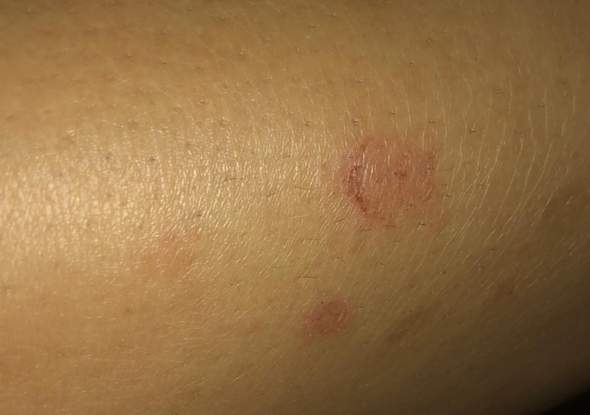 Was Ist Das Herpes Ein Pilz Oder Weisser Hautkrebs Kann Ein Arzt Seine Meinung Aussern Gesundheit Und Medizin Krankheit Was Ist Das Herpes Ein Pilz Oder Weisser Hautkrebs Kann Ein Arzt Seine Meinung Aussern Gesundheit Und Medizin Krankheit