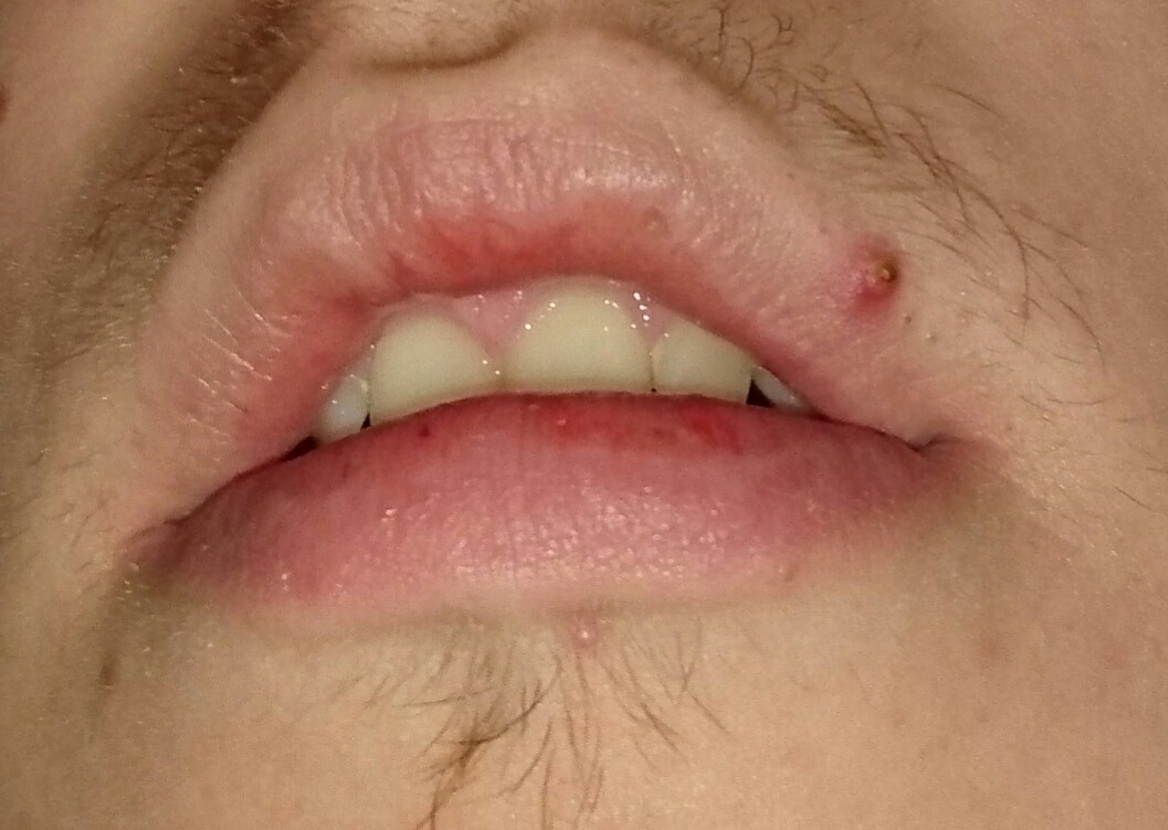 43+ Pickel An Der Lippe Ausdrücken Oder Nicht Pics