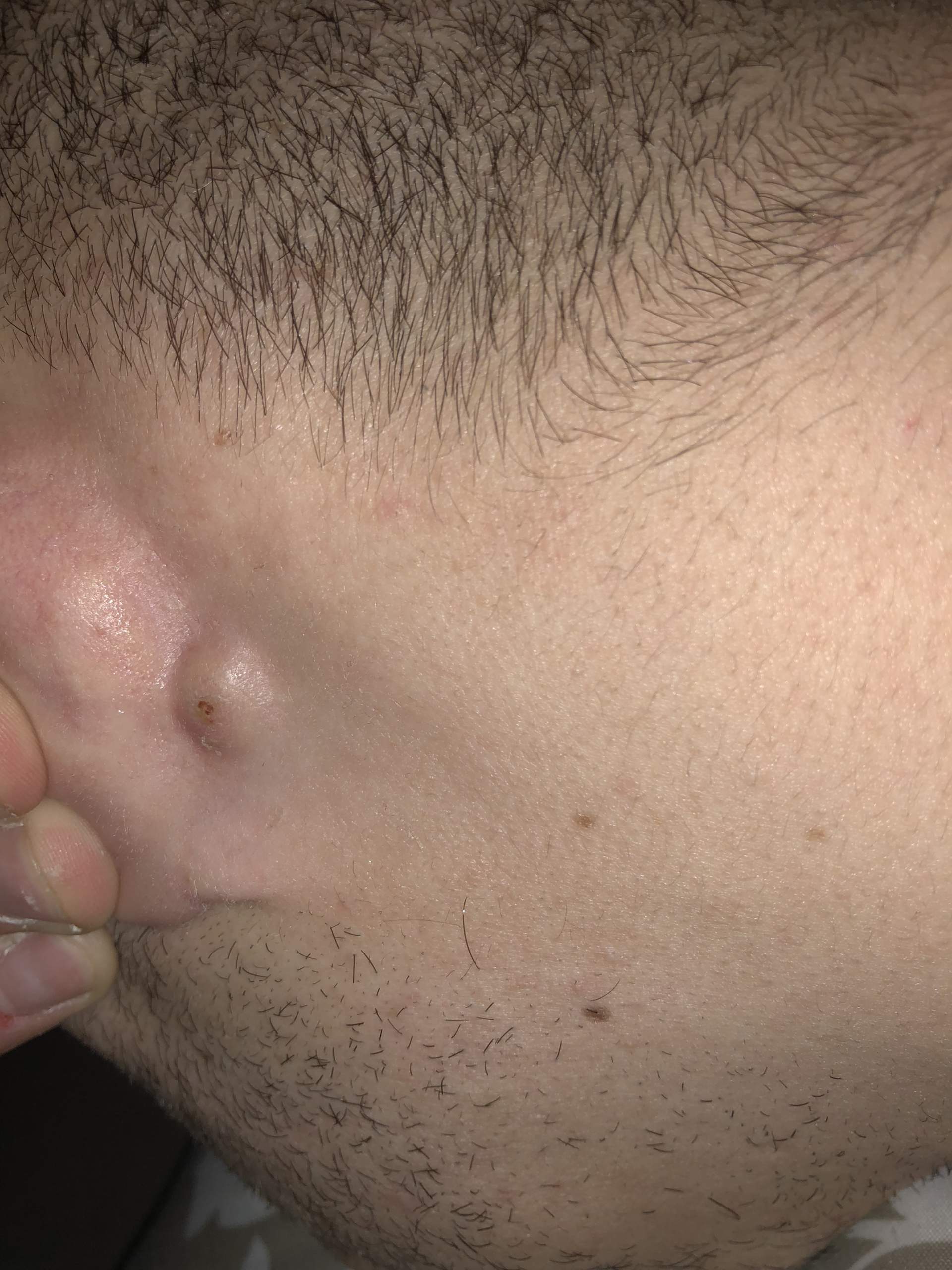 Was ist das hinter dem Ohr-Pickel,Abszess? (Krankheit)