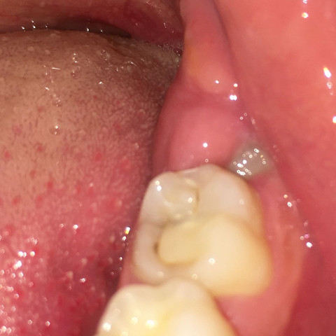 Hinter dem Backenzahn das geschwollene Zahnfleisch  - (Schmerzen, Zähne, Backenzahn)