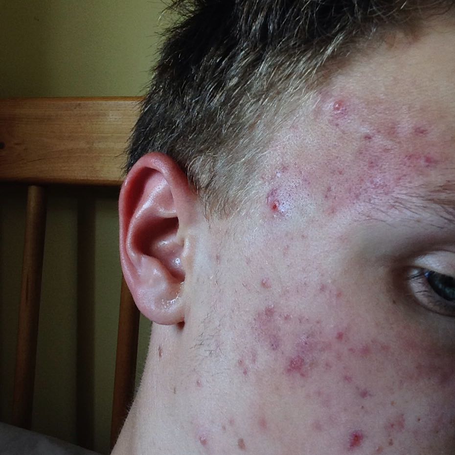 Pickelmale Rücken - Microneedling Ich Habe Einen Dermaroller Zu Hause Getestet Stern De - Jedoch pickel am kiefer