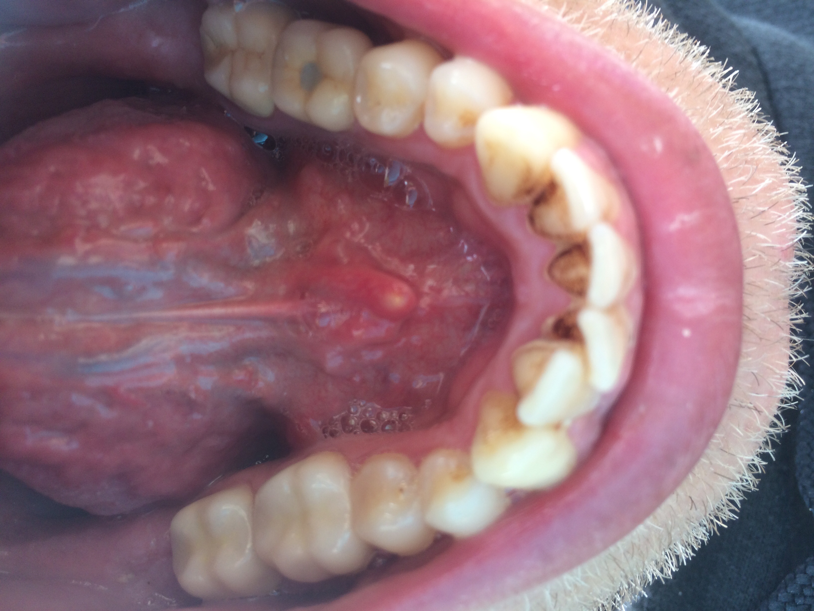 33+ Kleine Pickel Auf Der Zunge Hinten Images