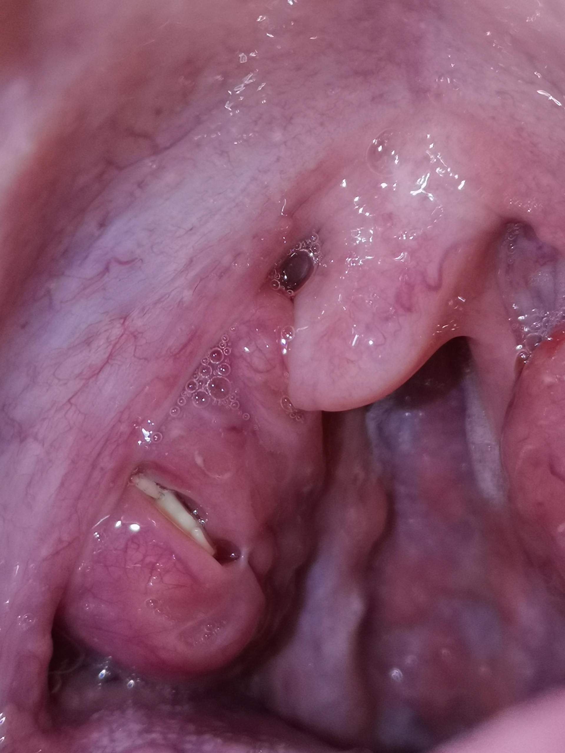 Mandelsteine Entfernen Mandelsteine Entfernen