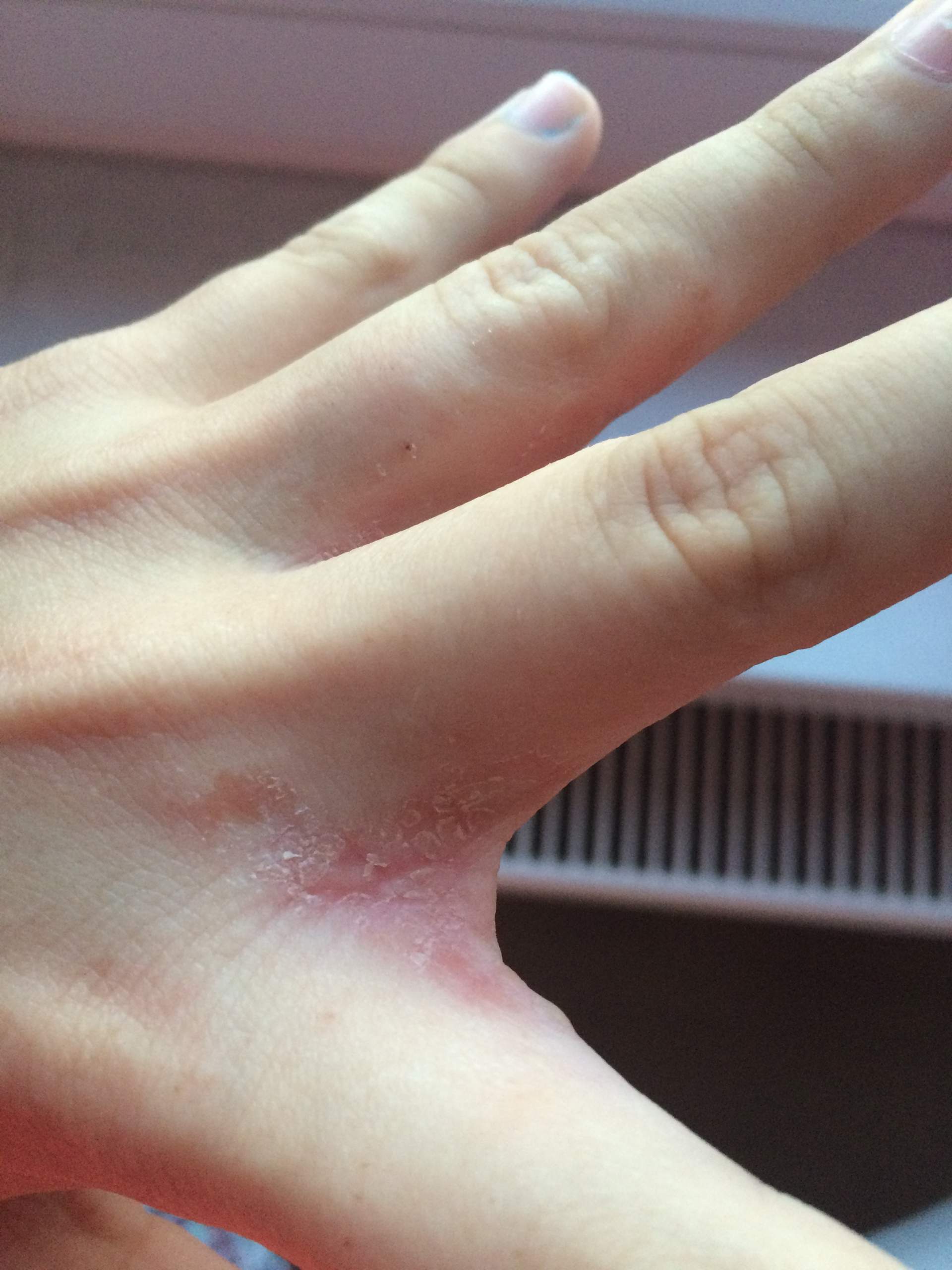 Was ist das in der Innenseite meiner Finger? (Krankheit)