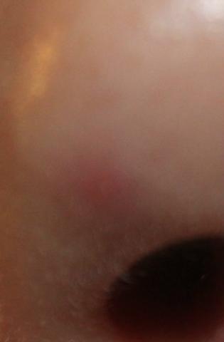 nase - (Haut, Pickel)